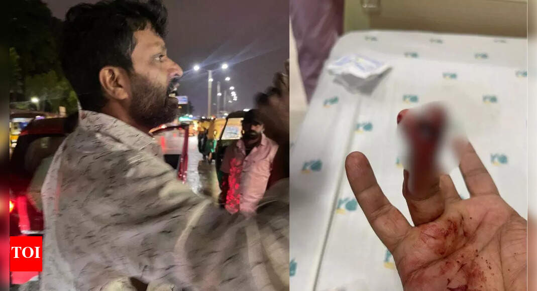 Bengaluru road rage: Man bites businessman's finger, surgery costs Rs 2 lakh | Bengaluru News