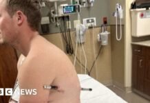 Man impaled by a hiking pole treks 10 miles down mountain