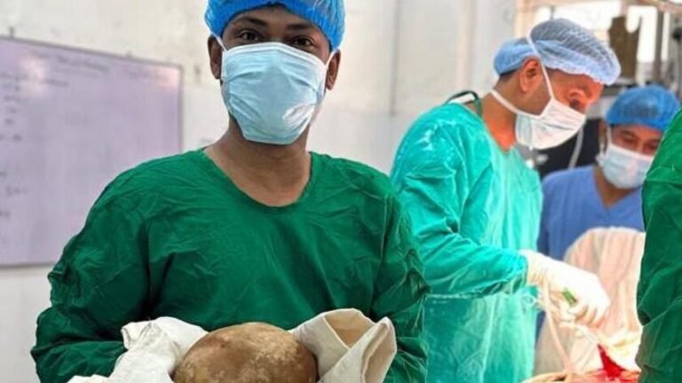Sri Lanka: Doctors remove 3.1kg stone from man’s bladder